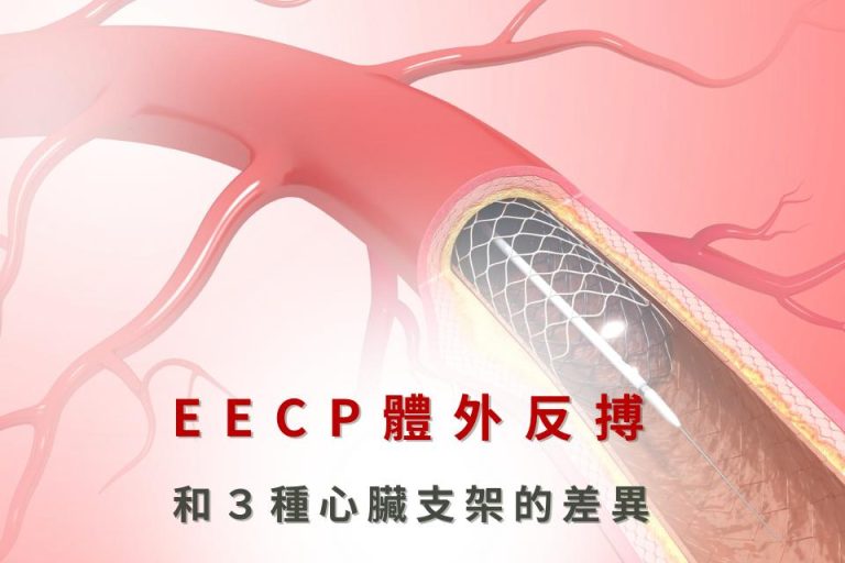 EECP體外反搏治療,與3種心臟支架治療方式的差異,幫助改善心血管健康。